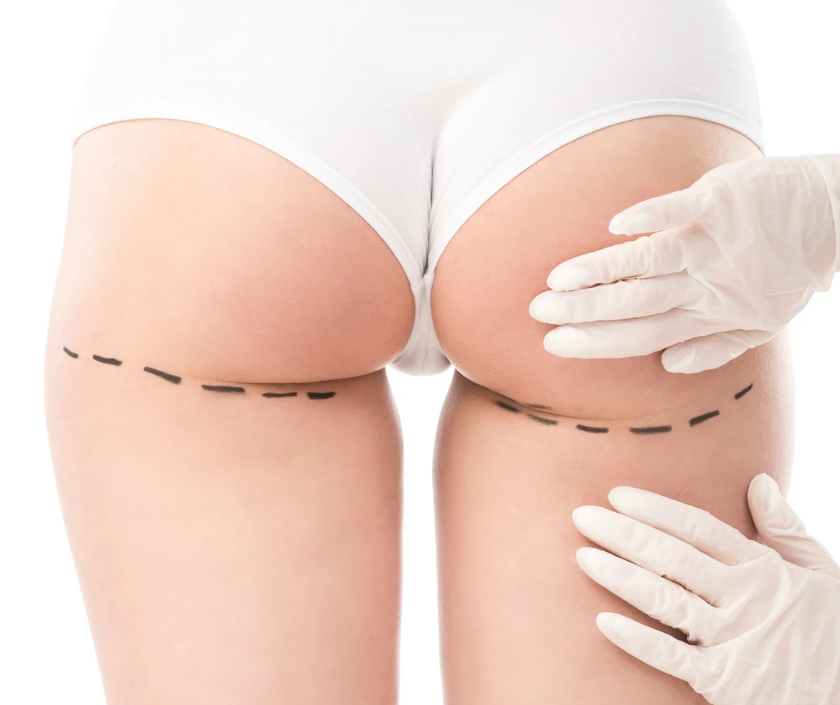 Buttock lift surgery for shape and firmness at Elegance Clinic Surat