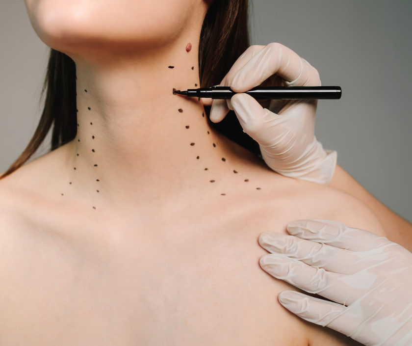 Neck lift to remove loose skin under the jaw at Elegance Clinic