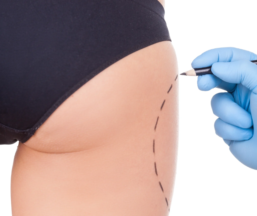 Thigh lift surgery for firmer inner thighs at Elegance Clinic