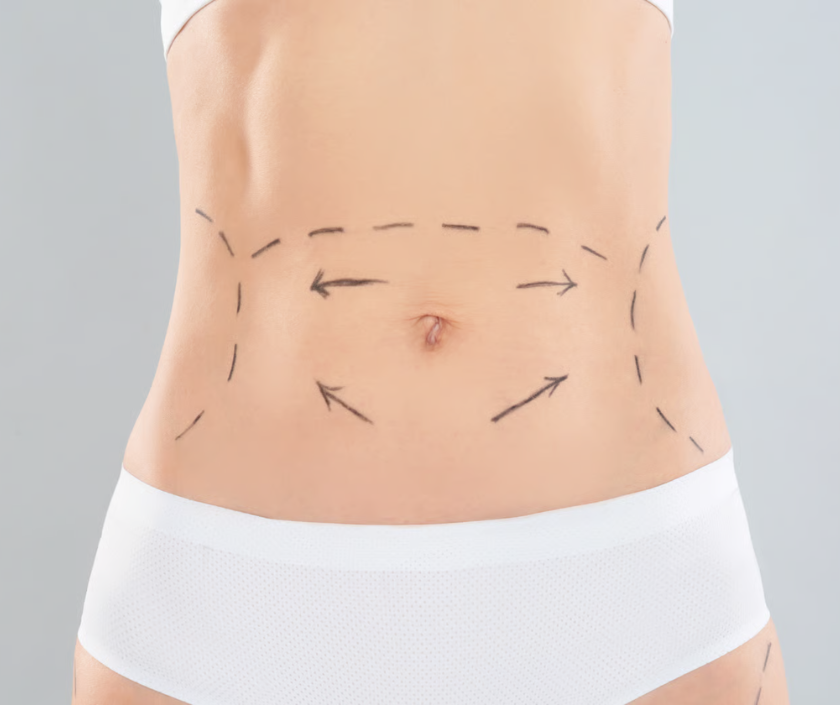 Tummy tuck procedure marking by Elegance Clinic, Surat